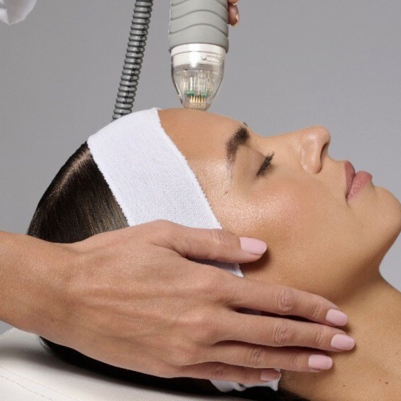 RF Microneedling