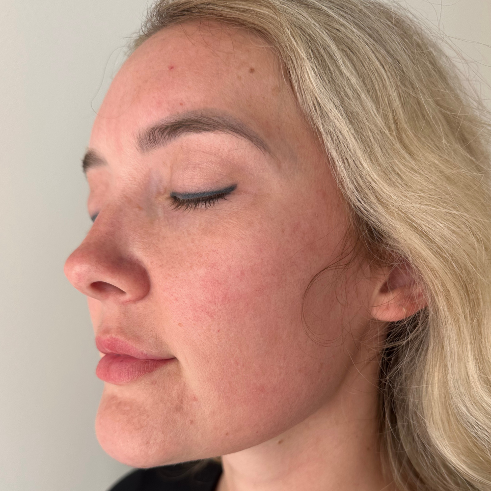 Microneedling – After