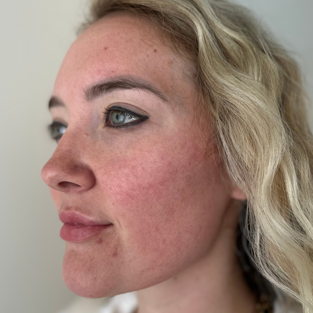 Microneedling – Before